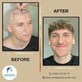 Résultats avant et après greffe de cheveux FUE au Medeks Hair Center, ligne restaurée