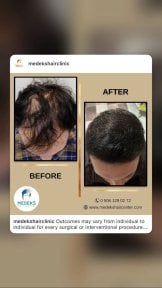 Résultat greffe de cheveux FUE avant/après au Medeks Hair Center, densité restaurée
