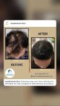 Résultat greffe de cheveux FUE avant/après au Medeks Hair Center, densité restaurée