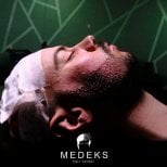 Résultat de greffe de barbe au Medeks Hair Center, greffons visibles sur la joue