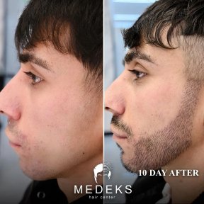 Avant et après greffe de barbe au Medeks Hair Center, résultat de pousse visible