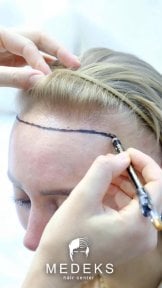 Conception de la ligne capillaire avant greffe chez Medeks Hair Center, préparation à un résultat naturel