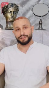Résultat précoce après greffe de cheveux au Medeks Hair Center, greffons visibles sur le cuir chevelu