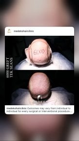 Résultat greffe de cheveux 6000 greffons avant/après au Medeks Hair Center, densité améliorée