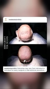 before-after photo fue-hair-transplant