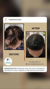 before-after photo fue-hair-transplant