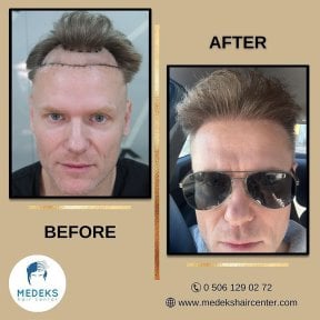 before-after photo hair-transplant