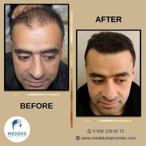 before-after photo hair-transplant
