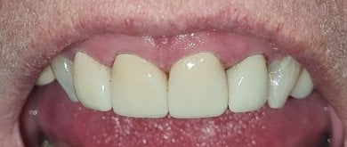 before-after photo dental-crown-installation