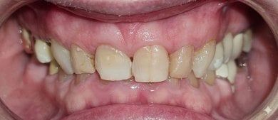 before-after photo dental-crown-installation