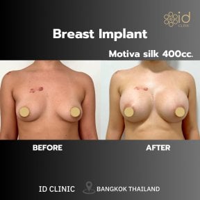 before-after photo breast-augmentation-with-silicone-implants