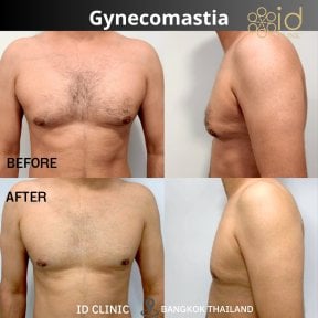 before-after photo liposuction
