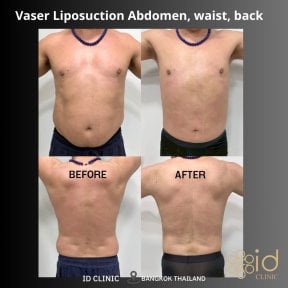 before-after photo vaser-liposuction