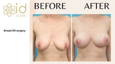 Before and after breast lift results at ID Clinic Bangkok, visible lift and firmer contour
