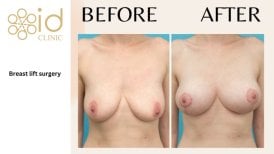 Before and after breast lift results at ID Clinic Bangkok, visible lift and firmer contour
