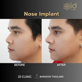 before-after photo rhinoplasty-nose-job