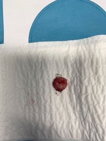 before-after photo cervical-conization-cone-biopsy