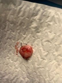 before-after photo cervical-conization-cone-biopsy