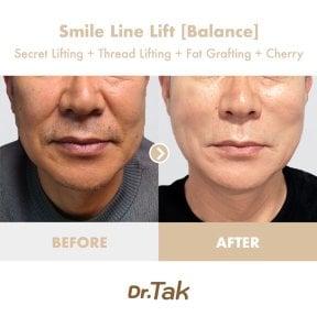 before-after photo tightening-of-facial-skin-facelift