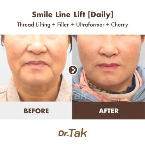 before-after photo tightening-of-facial-skin-facelift
