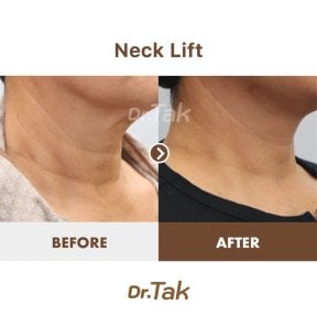before-after photo tightening-of-facial-skin-facelift