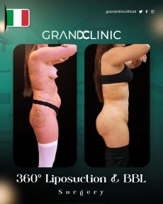 before-after photo liposuction