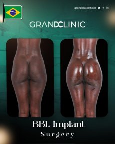 before-after photo liposuction