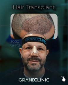 before-after photo afro-hair-transplant