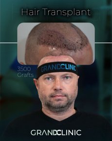 before-after photo afro-hair-transplant
