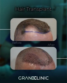 before-after photo afro-hair-transplant