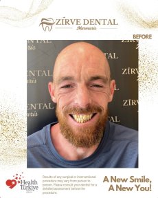 before-after photo zirconia-crown-installation