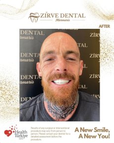 before-after photo zirconia-crown-installation