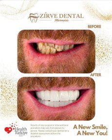 before-after photo zirconia-crown-installation