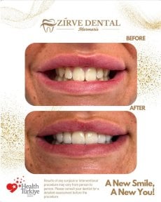 Efekty przed i po założeniu koron cyrkonowych w Marmaris Zirve Dental – poprawa uśmiechu