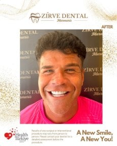 نتيجة تركيب تيجان الزركونيا في Marmaris Zirve Dental، ابتسامة مشرقة