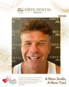 قبل تركيب تيجان الزركونيا في Marmaris Zirve Dental، تظهر فراغات وتغير لون الأسنان