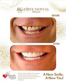 نتائج قبل وبعد تركيب تيجان الزركونيا في Marmaris Zirve Dental – ابتسامة جديدة