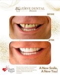 نتائج قبل وبعد تركيب تيجان الزركونيا في Marmaris Zirve Dental – ابتسامة جديدة