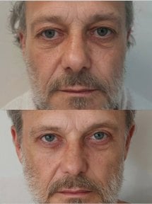 Résultats avant/après chirurgie des paupières à la Radzikowska Plastic Surgery Clinic