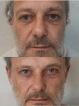 Résultats avant/après chirurgie des paupières à la Radzikowska Plastic Surgery Clinic