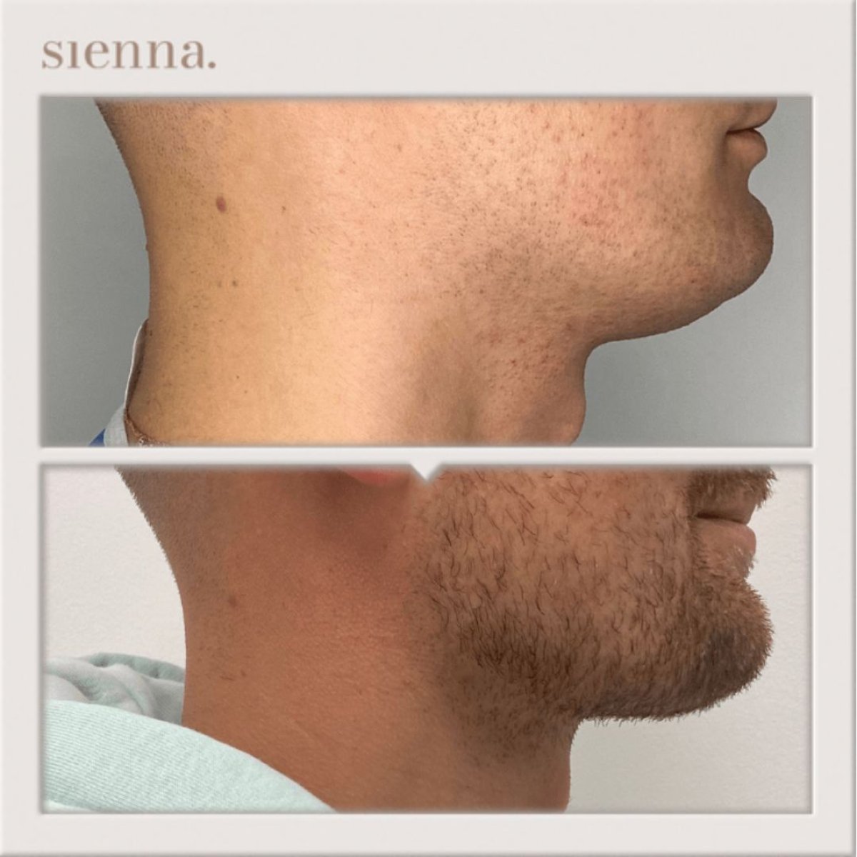 Resultados antes y después de liposucción de mentón en Sienna Clinic, contorno mejorado