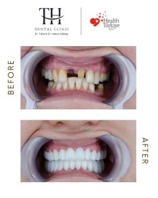Before and after dental implant results at TH Dental Clinic – restored smile transformation
