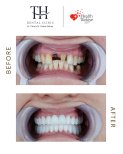 Before and after dental implant results at TH Dental Clinic – restored smile transformation