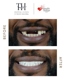 Before and after dental implant results at TH Dental Clinic – restored smile transformation