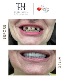 Before and after dental implant results at TH Dental Clinic – restored smile transformation