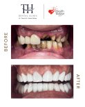 Before and after All-on-4 dental implants result at TH Dental Clinic – full smile restoration