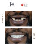 Before and after All-on-4 dental implants result at TH Dental Clinic, smile restoration
