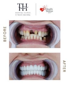 Efekt przed i po implantach All-on-4 w TH Dental Clinic – pełna odbudowa uśmiechu