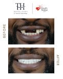 Efekt przed i po implantach All-on-4 w TH Dental Clinic – pełna odbudowa uśmiechu