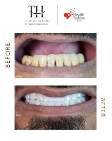 Efekt przed i po implantach All-on-4 w TH Dental Clinic – pełna odbudowa uśmiechu